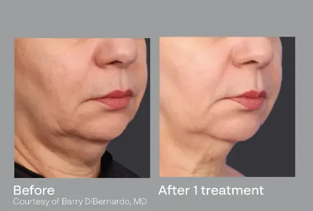 Manufacturer-supplied XERF before-and-after example after one treatment, courtesy of Barry DiBernardo, MD