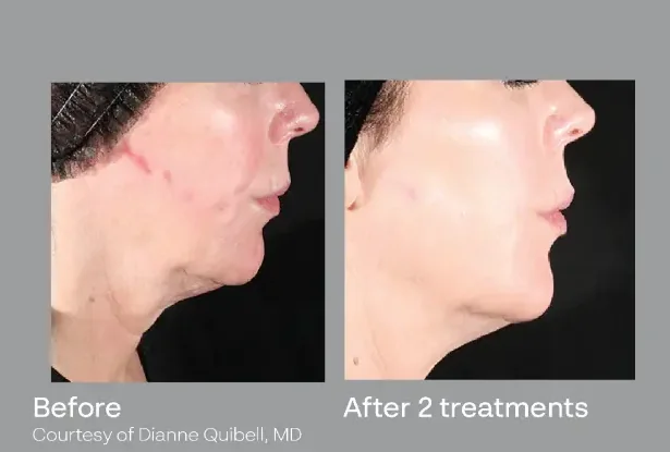 Manufacturer-supplied XERF before-and-after example after two treatments, courtesy of Dianne Quibell, MD